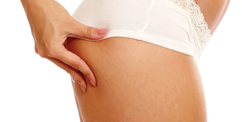 Celulitis