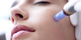 Microneedling